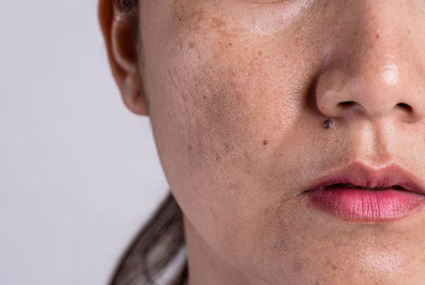 Cum se tratează melasma?